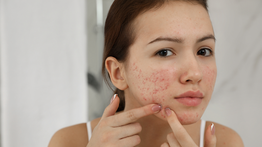 Woman with acne scars squeezing a pimple
