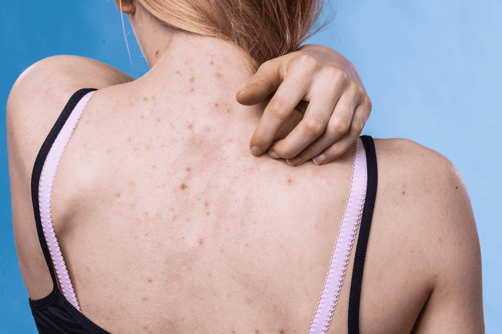 Woman touching her back with visible acne and skin irritation