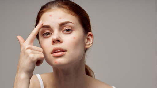 Woman with multiple pimples on face