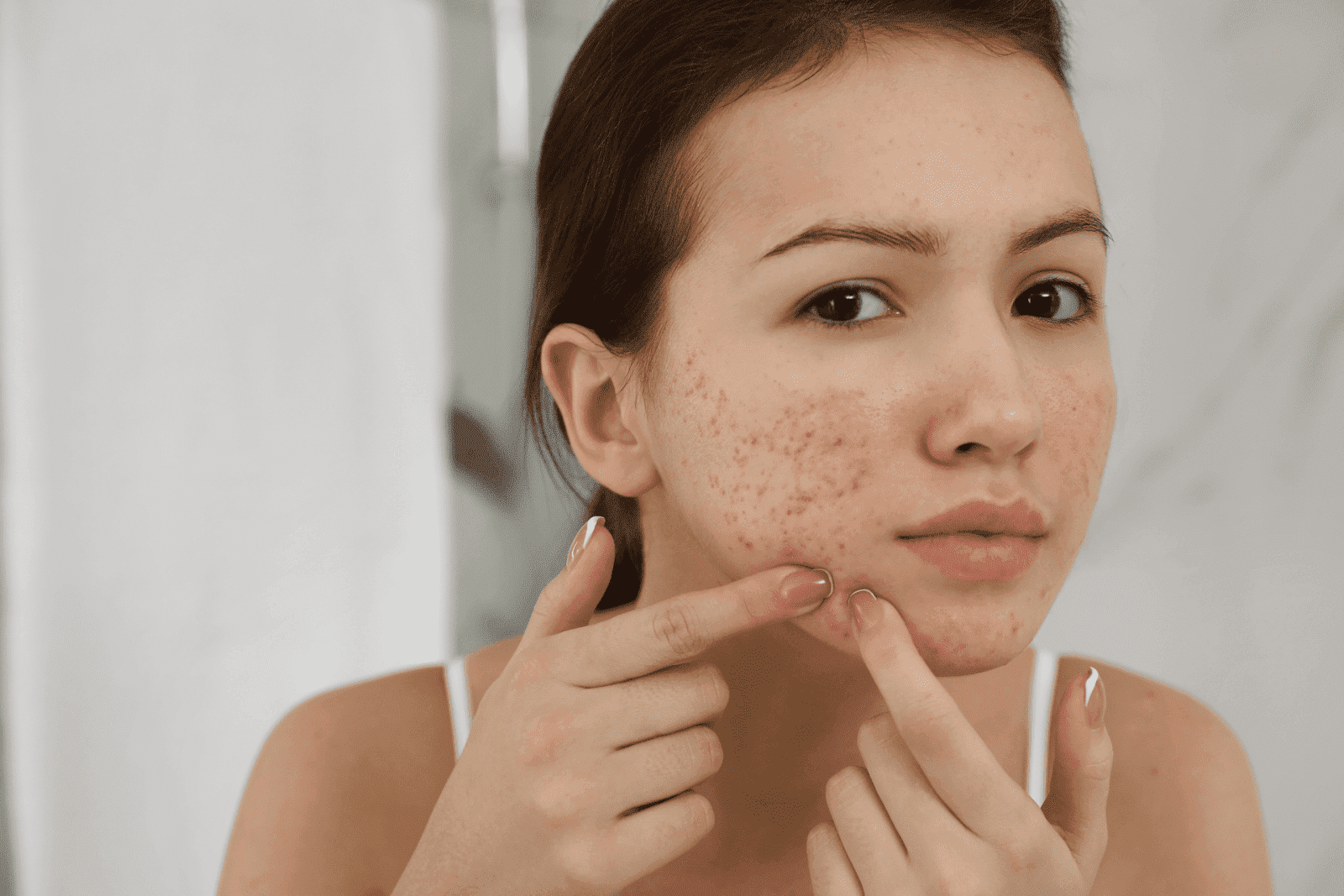 Young woman with inflamed acne squeezing a pimple on her cheek.